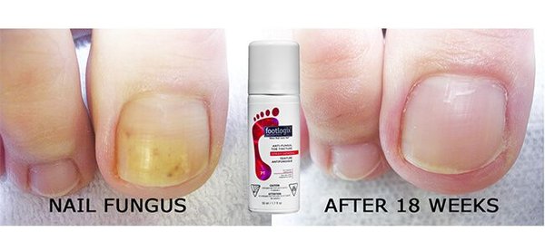 FOOTLOGIX SPIRALEEN NAIL TINCTURE ANTI FUNGUS POUR LES ONGLES 50ML 44G 0
