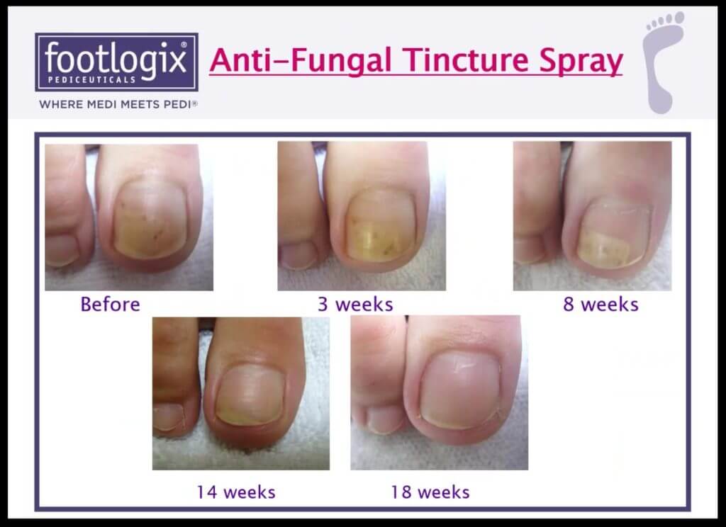 FOOTLOGIX SPIRALEEN NAIL TINCTURE ANTI FUNGUS POUR LES ONGLES 50ML 44G 0